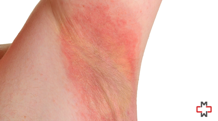 Yeast Rash Under Arms