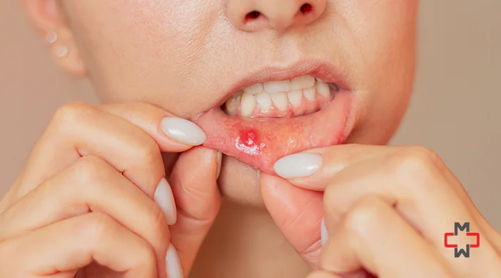 How To Get Rid of a Canker Sore in 24 Hours