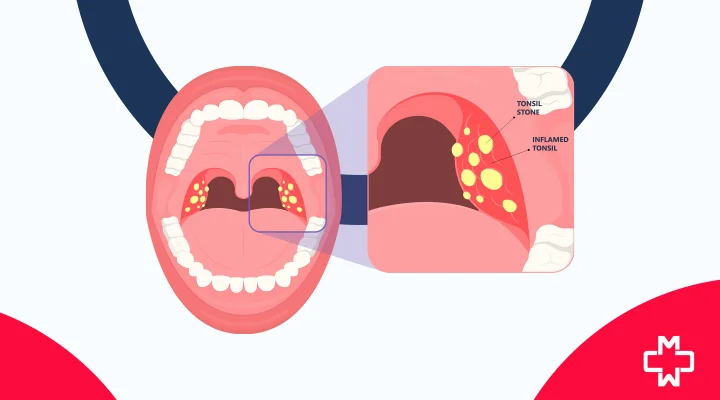 Tonsil Stones