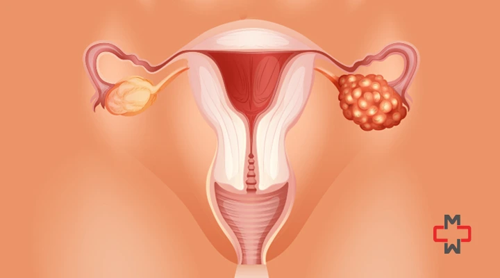 What to Know About Ovarian Cancer: A Comprehensive Guide