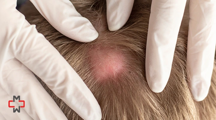 Why Does the Lump on My Head Hurt When I Press it?