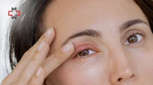 woman with swollen red stye on upper eyelid touching eye
